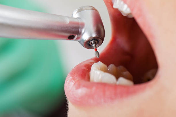 Best Emergency Treatment for Toothache in Roscoe, TX